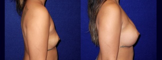 Right Profile View - Breast Augmentation - Breast Asymmetry Correction