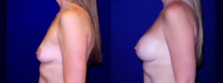 Left Profile View - Breast Augmentation After Pregnancy - Silicone Implants