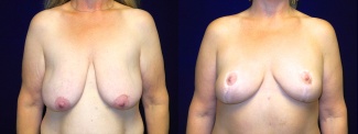 Frontal View - Breast Lift After Massive Weight Loss