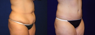 Right 3/4 View - Abdominoplasty After Massive Weight Loss