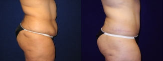 Right Profile View - Abdominoplasty After Massive Weight Loss