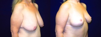 Right 3/4 View - Breast Lift After Massive Weight Loss