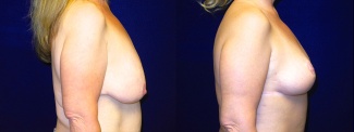 Right Profile View - Breast Lift After Massive Weight Loss