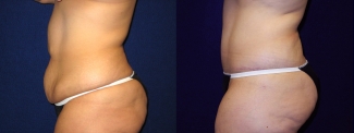 Left Profile View - Abdominoplasty After Massive Weight Loss
