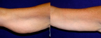 Frontal View - Right Arm - Arm Lift After Weight Loss