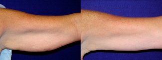 Frontal View - Left Arm - Arm Lift After Weight Loss