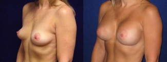 Left 3/4 View - Breast Augmentation - Silicone Implants