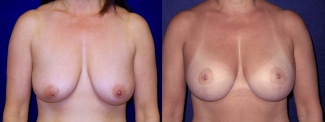 Frontal view - Breast augmentation with Lift