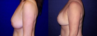 Left profile view - Breast augmentation with Lift