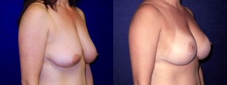 Right 3/4 view - Breast augmentation with Lift