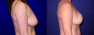 Right profile view - Breast augmentation with Lift