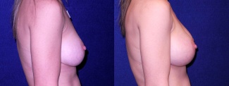 Right Profile View - Implant Revision