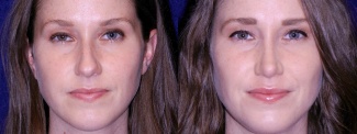 Frontal View - Rhinoplasty