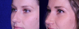 Left 3/4 View - Rhinoplasty