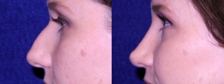 Left Profile View - Rhinoplasty