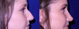 Right Profile View - Rhinoplasty