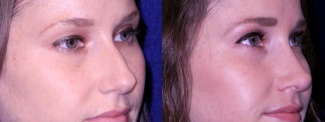 Right 3/4 View - Rhinoplasty