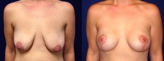Frontal View - Breast Augmentation with Lift After Pregnancy