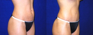 Right 3/4 View - Tummy Tuck After Pregnancy