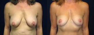 Frontal View - Breast Lift After Pregnancy