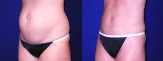 Left 3/4 View - Tummy Tuck