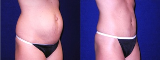 Right 3/4 View - Tummy Tuck