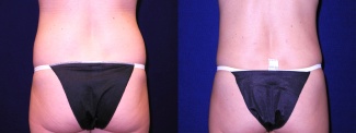 Posterior View - Tummy Tuck