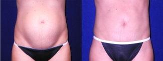 Frontal View - Tummy Tuck