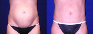 Frontal View - Tummy Tuck