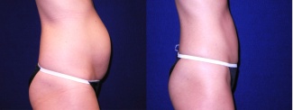 Right Profile View - Tummy Tuck