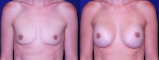 Frontal View - Breast Augmentation