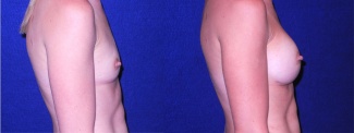 Left Profile View - Breast Augmentation