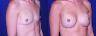 Right 3/4 View - Breast Augmentation