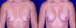 Frontal View - Breast Augmentation