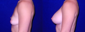 Left Profile View - Breast Augmentation