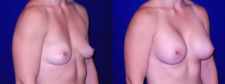 Right 3/4 View - Breast Augmentation