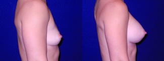 Right Profile View - Breast Augmentation