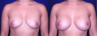 Frontal View - Breast Augmentation