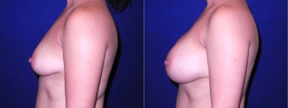 Left Profile View - Breast Augmentation