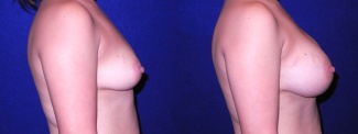 Right Profile View - Breast Augmentation