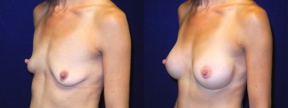 Left 3/4 View - Breast Augmentation with Lift