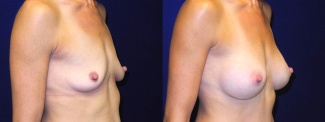 Right 3/4 View - Breast Augmentation with Lift