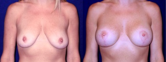 Frontal View - Breast Augmentation with Lift