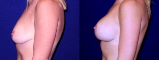 Left Profile View - Breast Augmentation with Lift