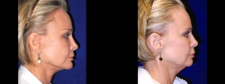 Right Profile - Facelift, Browlift, Chin Implant