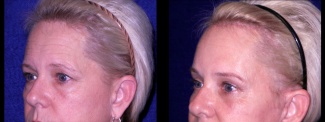 Left 3/4 View Close Up - Facelft, Browlift and Upper Eyelid Surgery