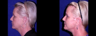 Left Profile View - Facelft, Browlift and Upper Eyelid Surgery