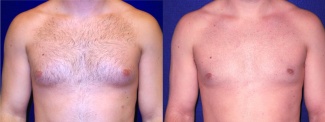 Frontal View - Gynecomastia