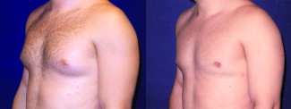 Left 3/4 View - Gynecomastia