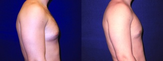 Right Profile View - Gynecomastia